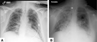 368 x 480 jpeg 38 кб. Jci The Acute Respiratory Distress Syndrome