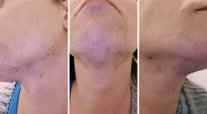 How many laser treatments to. Laser Hair Removal For Trans Women Gendergp Transgender Services