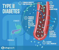 Signs and symptoms of type 2 diabetes often develop slowly. Diabetes Symptoms Diagnosis Treatments Complications