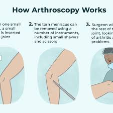 Arthroscopic surgery, also called keyhole surgery, is far less invasive and associated with shorter. Meniscectomy Preparation To Recovery