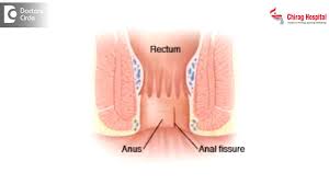 How is Botulinum toxin used to treat anal fissures? - Dr. Rajashekhar -  YouTube