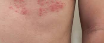 Sie treten in zeiten psychischer belastung und bei einer schwäche des immunsystems auf. Welche Spatfolgen Konnen Durch Eine Gurtelrose Ausgelost Werden