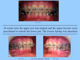 Learn about surgery, treatment, recovery times, and symptoms of a fractured jaw. American Association Of Orthodontists 112th Annual Session Honolulu Hawaii May 4 8 2012 Forsus Rme Combination Frc A Non Compliance Multifunctional Onephase Ppt Download
