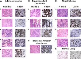 While mesothelioma on average is only diagnosed in about 3,000 new cases in the u.s. Immunohistochemical Demonstration Of Casm Protein Overexpression In Download Scientific Diagram