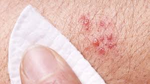Image result for shingles