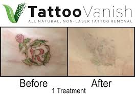 We did not find results for: Tattoo Vanish The Best All Natural Non Laser Tattoo Removal Fast Eyebrow Tattoo Removal Near Me Tattoo Removal Cream