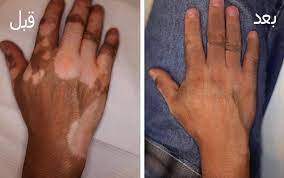 علاج مرض البرص home facebook