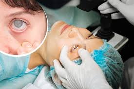 Image result for Cataract Extraction