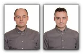 Forum, viele tipps bei haarverlust und glatze! Haartransplantation