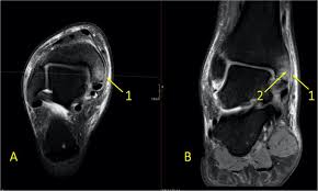The anterior talofibular ligament attaches the anterior margin of the lateral malleolus to the adjacent region of the. Traumatic And Non Traumatic Bone Marrow Edema In Ankle Mri A Pictorial Essay Insights Into Imaging Full Text