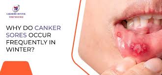 Image result for Canker sores roof of mouth
