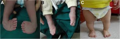 Most of the time, it is not associated with other problems. A Polyaxial Fixation Brace For The Treatment Of Idiopathic Congenital Talipes Equinovarus In Newborns Journal Of Orthopaedic Surgery And Research Full Text