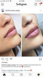 Pin By Kaleb On Stylish Lips Inspiration Lip Fillers Juvederm Lip Fillers