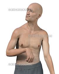 Image result for Chorea