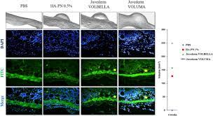 The search coil is the part which picks up all the metals detected and relays it back to the control box. Comparative Evaluation Of The Effectiveness Of Novel Hyaluronic Acid Polynucleotide Complex Dermal Filler Scientific Reports