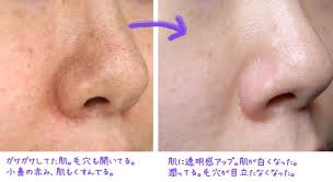 セラミドは 水分を保持する高い保湿成分なんだそうです 人間の肌の中に もともとあって保水と保湿を同時にする役割をしている 水分をたっぷり吸着して保持するセラミドは 肌の表面近くにある角質層の中に 肌 くすみ セラミド 顔 毛穴