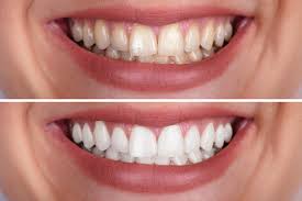 Apply the hydrogen peroxide gel directly to your teeth. Teeth Whitening Kit Custom Whitening Trays Coolum Dentist