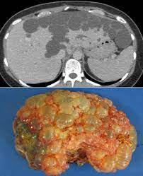 Polycystic Liver Disease Radiology At St Vincent S University Hospital