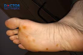 Image result for brown patches on the feet