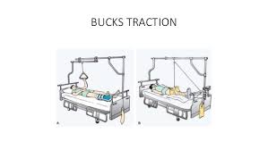 Allows more movement in bed. Splints And Tractions