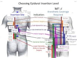 Insertion Site And Epidural Level Needed For Different