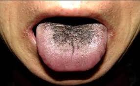 Image result for black hairy tongue symptoms