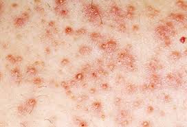 Hello all, my 1st post on here. Skin Problems Skin Conditions Below The Waist