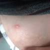Breast cancer is most often associated with having a breast lump. 1