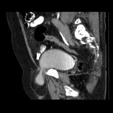 Inguinal Hernia Containing Urinary Bladder Radiology Case Radiopaedia Org