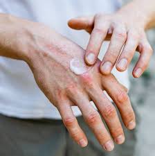 Klinik pakar kulit dr mohd noh. Eczema Treatment In Singapore Dedicated Dermatologist