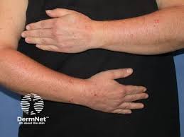Image result for Papular urticaria