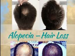 9699011786 / 9930205157 / 8286559726. Al Ashhar Hair Clinic Hijama Center Skin Hair Growth Best Hair Treatment Natural Hair Transplant Best Hair Transplant Hair Specialist Hair Loss Hair Fall Non Surgical Hair Replacement Back Pain Relief