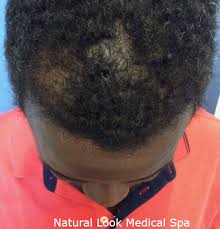Men with thin hair usually avoid experimenting with long hairstyles black males tend to lose their hair for the same reasons as other races, including male pattern baldness. Prp Hair Restoration For Men And Women Natural Look Medical Spa