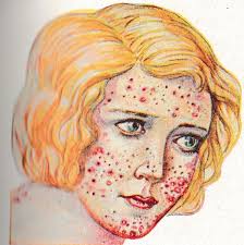 Un bon programme pour mettre fin à votre accoutumance au tabac prend en compte à la fois le défi de court terme d'arrêter de fumer et le défi de long terme d'éviter de se remettre au tabac. L Acne Decouvrez Comment Vous Soigner Avec Un Magnetiseur Guerisseur