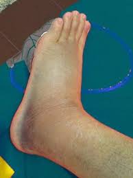 Maybe you would like to learn more about one of these? Terseliuh Atau Tergeliat Kaki Terapi Qun Urutan Tok Zul ÙÙŠØ³Ø¨ÙˆÙƒ