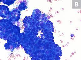Check spelling or type a new query. Effusion Cytology Clinician S Brief