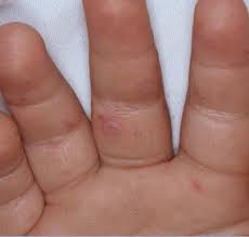Check spelling or type a new query. Hand Foot And Mouth Disease Fv Hospital