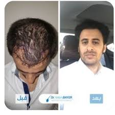 تكلفة زراعة الشعر في تركيا Doctor Incoming Call Screenshot