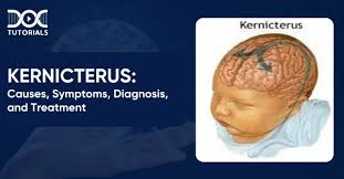 Image result for Kernicterus