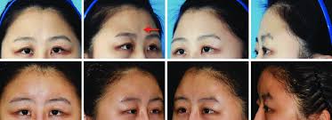 I can't breathe at all. A 22 Year Old Woman Presented With Complaints Of Flat Forehead Contour Download Scientific Diagram