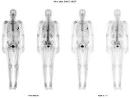 Prostatic Carcinoma Ranks As The Most Common Malignant Tumour In Men And The Second Most Common Cause Of Cancer Related Deaths In Men Prostatic Adenocarcinoma