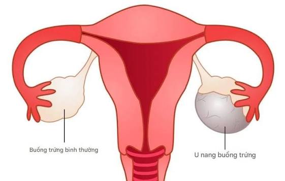 Triệu chứng u nang buồng trứng có thể thay đổi theo chu kỳ nội tiết và đặc điểm khối u nên không xuất hiện liên tục