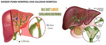 Tanda paling jelas apabila warna kulit atau mata putih pesakit menjadi kekuningan. Kanser Pundi Hempedu Dan Saluran Hempedu Cancer Resource Education Center Care