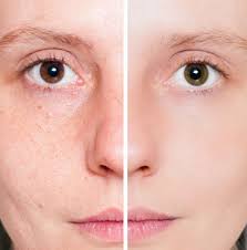 Cuidados Com A Pele Fotografias De Banco De Imagens Imagens Livres De Direitos Autorais Cuidados Com A Truques De Estetica Marcas De Acne Tratamentos De Pele