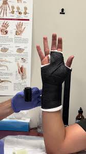 Image result for Radial Gutter Cast