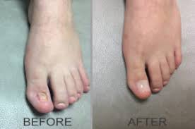 The outcome is pain, soreness, swelling and, in some cases, an infection. Common Causes And Treatments For Ingrown Toenails Ntfantfa