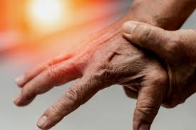 Image result for Hand Extensor Tendon Injury