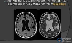 The best gifs for 阿茲海默症 失智症. æ²ˆé»˜æ®ºæ‰‹å¤±æ™ºç—‡å°ç£65æ­²ä»¥ä¸Šæ¯13äººä¸­å°±æœ‰1ä½ Ettodayå¥åº·é›² Ettodayæ–°èžé›²