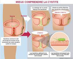 Articles sur le meme sujet. Infections Urinaires Symptomes Traitements Creapharma