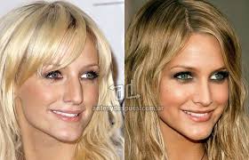 Pin On Best Cosmetic Rhinoplasty Surgeon In Florida